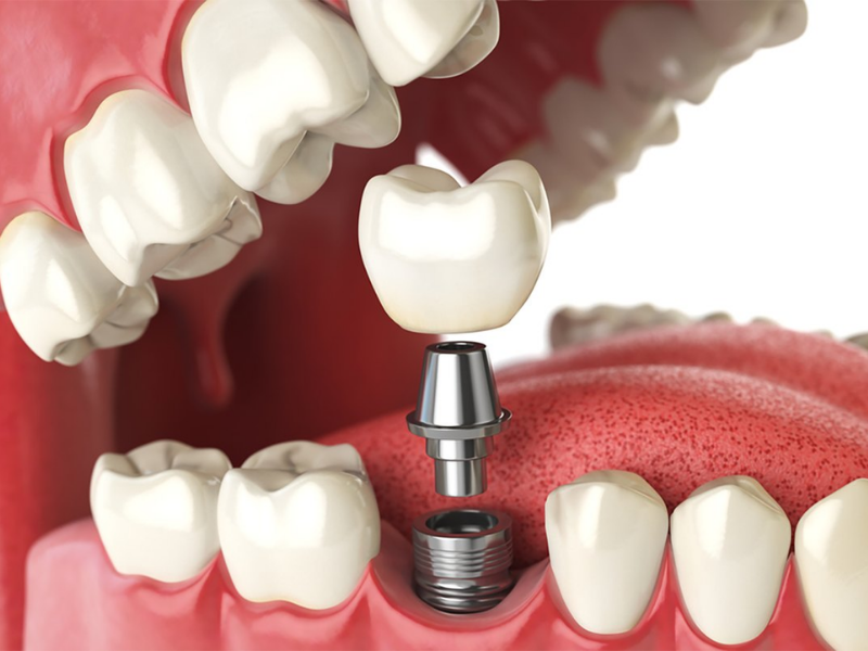 Implante Dentário